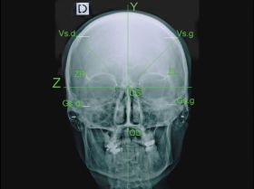 Norma Frontalis Application