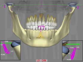 DAM Adaptive Major: Hyper Condyle D