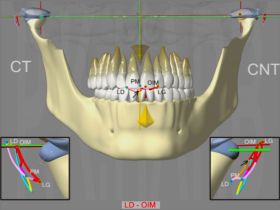 DAM Pathologique Articulaire : luxation reductible gauche