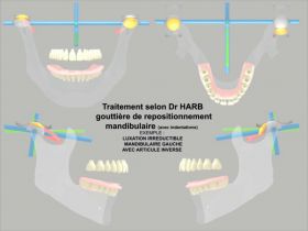 Les diffrentes gouttires occlusales