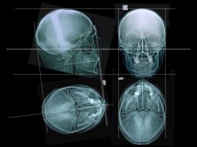 Three-dimensional cephalometric assembly