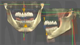 Traitement dfinitif par Multi-attache selon les orthodontistes