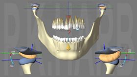 Traitement dfinitif par Multi-attache