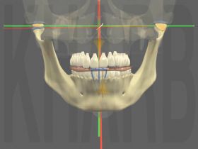 Traitement provisoire par gouttire occlusale par les Occlusodontistes