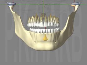 Traitement provisoire par Guide Mandibulaire Conjoint