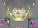 DAM Adaptive Major: Hyper Condyle D