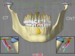 DAM Adaptive major: DOF with CB G