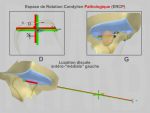 Physiological Condylar Rotation space (ERCP) / Centered Functional Rel